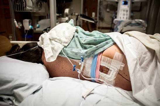 epidural
