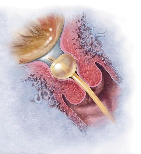 Foley-balloon-catheter-being-inserted